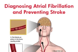 Gia tăng người đột quỵ do rung nhĩ