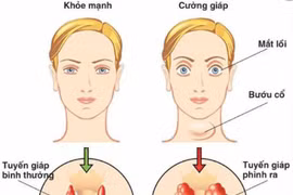 Basedow xuất hiện sau stress có thể tự khỏi