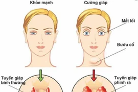 Basedow xuất hiện sau stress có thể tự khỏi