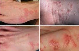 Bác sĩ điểm mặt các bệnh da liễu hay gặp khi vào hè