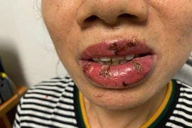 Nhiễm trùng nặng vì xăm môi ở cơ sở thẩm mỹ không đảm bảo
