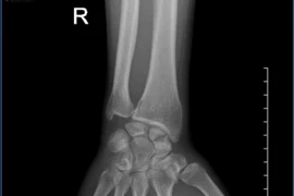 Đau cổ tay kéo dài hình thành khớp giả xương thuyền