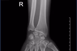 Đau cổ tay kéo dài hình thành khớp giả xương thuyền