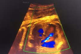 Không khám sàng lọc, phát hiện con bị down lúc sắp sinh