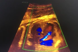 Không khám sàng lọc, phát hiện con bị down lúc sắp sinh