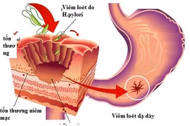 Chuyên gia mách cách phòng ngừa viêm loét dạ dày, tá tràng?