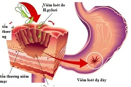 Chuyên gia mách cách phòng ngừa viêm loét dạ dày, tá tràng?