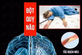 Nhận biết sớm thể đột quỵ não tránh biến chứng nguy hiểm