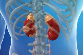 Dấu hiệu cảnh báo ung thư thận