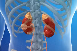 Dấu hiệu cảnh báo ung thư thận