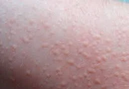 Cách phòng ngừa mày đay bùng phát khi trời lạnh