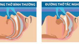 Hỏng mắt vì chứng ngưng thở khi ngủ