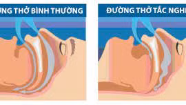 Hỏng mắt vì chứng ngưng thở khi ngủ
