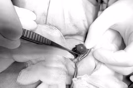 Bé trai 2 tuổi phải cắt bỏ tinh hoàn vì xoắn tinh hoàn