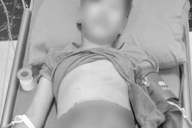 Hy hữu: bé trai 11 tuổi bị lóc toàn bộ da, cơ vùng bụng, đùi