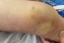 Nhiều người cứng khớp, teo cơ vì tiêm khớp không an toàn