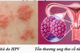 Chuyên gia mách cách phòng ngừa virus HPV gây nhiều bệnh ung thư ở người