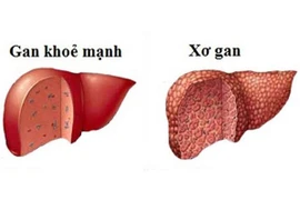 Cách điều trị men gan tăng cao