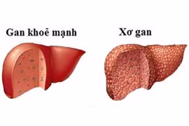Cách điều trị men gan tăng cao