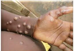 Ca tử vong do đậu mùa khỉ đầu tiên tại Việt Nam