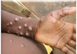 Ca tử vong do đậu mùa khỉ đầu tiên tại Việt Nam