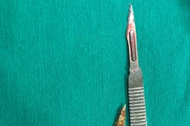 Xương gà trú ngụ nhiều năm đâm thủng trực tràng