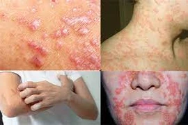 Cách phòng bệnh da liễu khi thời tiết thay đổi