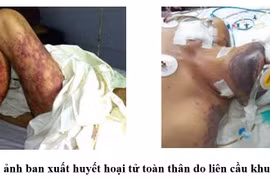 Nguy kịch do ăn tiết canh, thịt lợn: Phòng tránh thế nào?