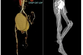  Bị cắt cụt chi vì không biết chân đau và lạnh là bệnh nguy hiểm