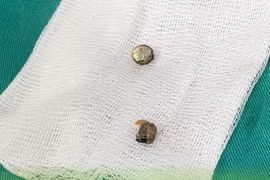 Gắp dị vật trong âm đạo bé 5 tuổi