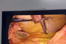 Uống thuốc khớp, cụ ông 72 tuổi phải cấp cứu khâu lỗ thủng dạ dày