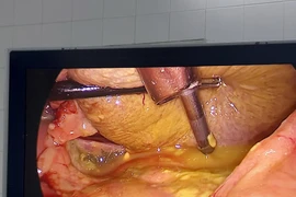 Uống thuốc khớp, cụ ông 72 tuổi phải cấp cứu khâu lỗ thủng dạ dày