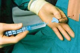 Giảm đau ngoài màng cứng điều trị viêm tụy cấp