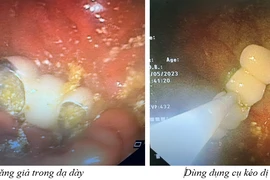 Hy hữu: 4 răng giả rơi vào dạ dày