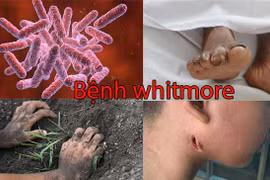 Bộ Y tế khuyến cáo cộng đồng phòng chống bệnh Whitmore