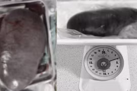 Hy hữu: Lách khổng lồ nặng 4kg chiếm hơn nửa ổ bụng quý ông 61 tuổi