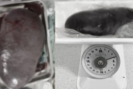 Hy hữu: Lách khổng lồ nặng 4kg chiếm hơn nửa ổ bụng quý ông 61 tuổi