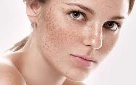 Muốn trị nám hiệu quả cần nắm rõ các nguyên tắc này