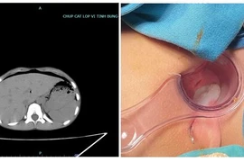Bé 8 tuổi thủng trực tràng do bạn trêu ngồi vào chiếc bút dựng ngược