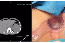 Bé 8 tuổi thủng trực tràng do bạn trêu ngồi vào chiếc bút dựng ngược