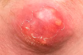 Cách xử lý mụn nhọt, tránh nhiễm trùng nguy hiểm