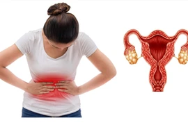 Metformin điều trị buồng trứng đa nang