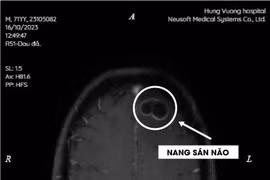 Thích ăn tiết canh, liên tiếp hai bệnh nhân bị nang sán trong não