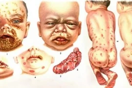 Sàng lọc giang mai khi mang thai tránh bệnh lý nguy hiểm cho con