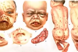 Sàng lọc giang mai khi mang thai tránh bệnh lý nguy hiểm cho con