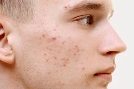 Bác sĩ da liễu chỉ rõ nguyên tắc trị mụn trứng cá hiệu quả