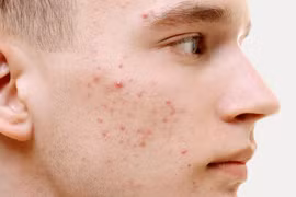 Bác sĩ da liễu chỉ rõ nguyên tắc trị mụn trứng cá hiệu quả