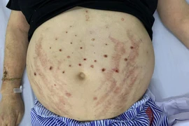 Phù và nhiễm trùng nặng do dùng ong châm chữa bệnh