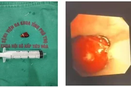 Hạt hồng xiêm trú trong phế quản 10 ngày