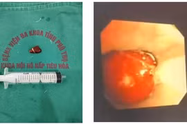 Hạt hồng xiêm trú trong phế quản 10 ngày